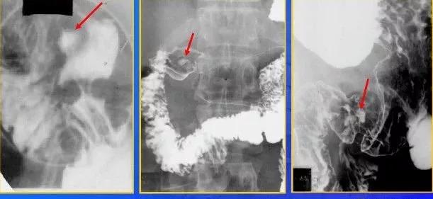十二指肠球部溃疡解剖位置,十二指肠球部溃疡x线表现