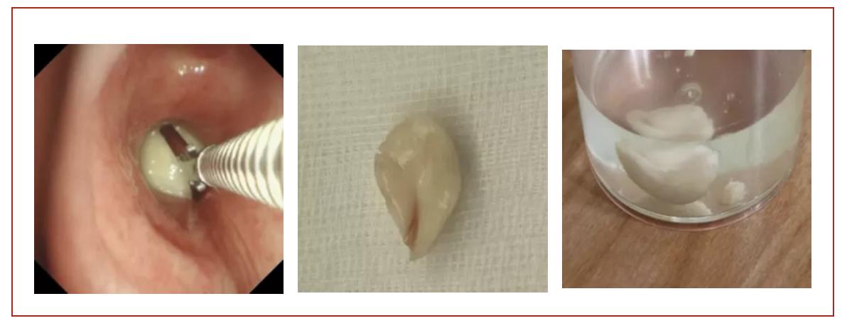 气管呛入异物最佳处理方法,呛住气管异物怎么自救