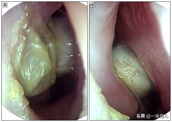 5岁鼻异物，18岁仍作妖！儿童发生鼻腔异物，先来做好这4步