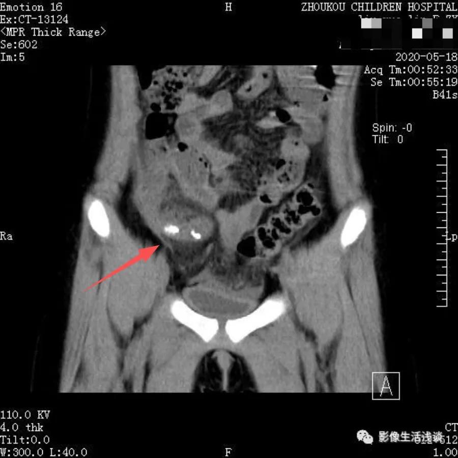小朋友腹痛呕吐无其他症状,孩子有腹痛呕吐症状家长切莫大意