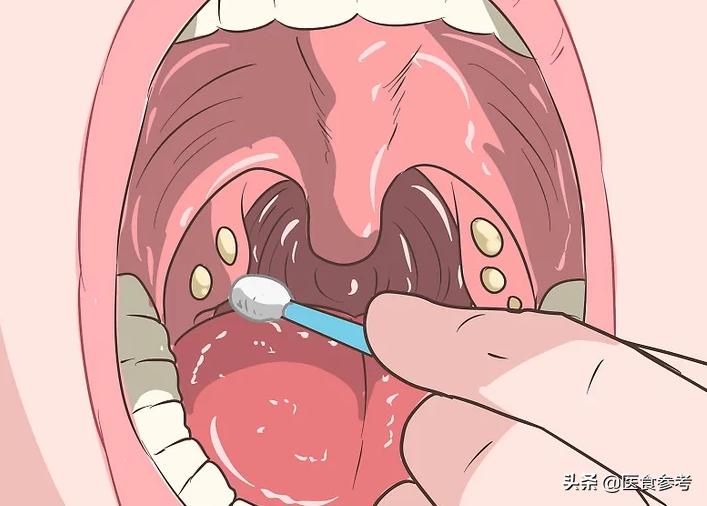 咽部有异物感咳出小肉球,咽部异物感引发咳嗽