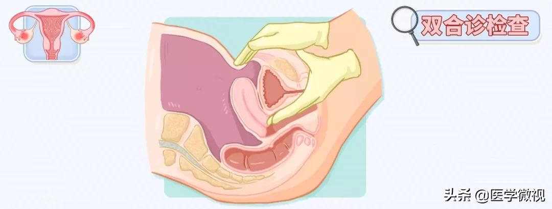 女性得了盆腔炎要注意什么,女性得盆腔炎是怎么造成的