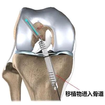前叉重建术后0～4周康复计划