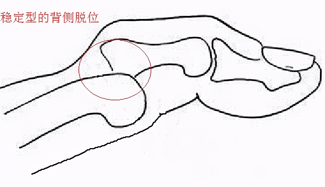 肩关节脱位骨折康复,跗跖关节骨折脱位康复视频