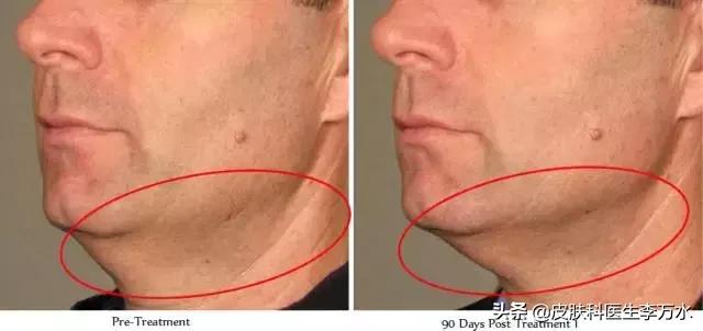 张雨绮说超声刀就像在烤肉？！线雕和超声刀，究竟哪个更靠谱？