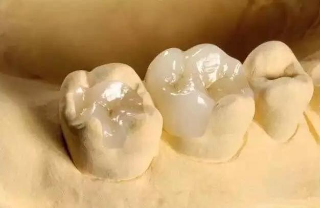 补牙树脂修复牙齿,大连市口腔医院牙齿修复