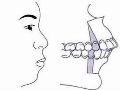 未成年人牙齿矫正会反弹吗,牙齿矫正后反弹的补救方法
