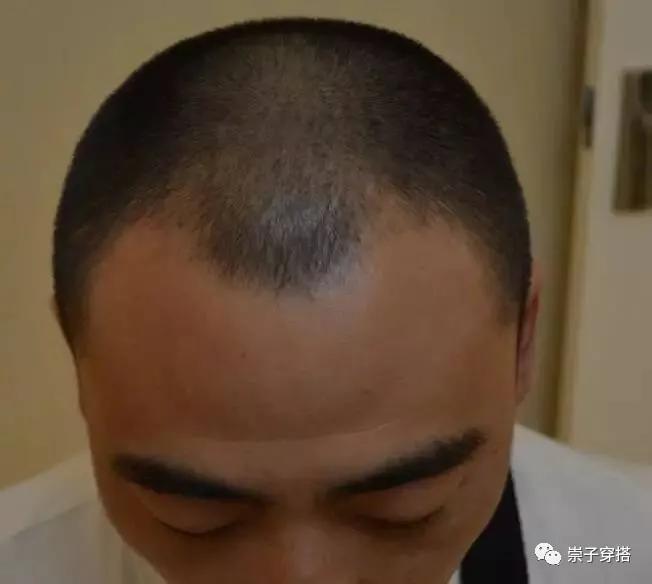 男士额头比较窄的怎么理发,额头窄适合理发吗男生