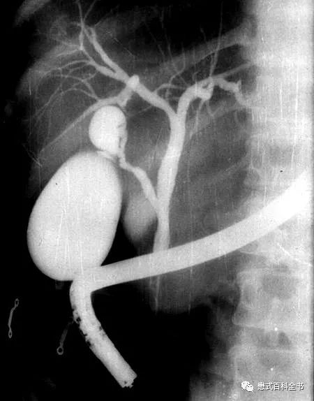 开展mrcp技术,mrcp检查操作流程