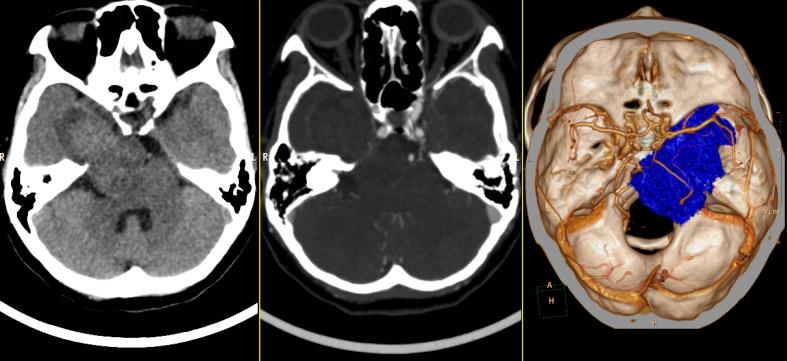 查出恶性肿瘤做手术能好吗,良性脑肿瘤手术费用