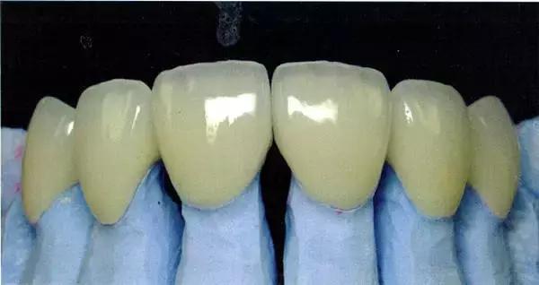 烤瓷牙金属露出来了有毒吗,烤瓷牙内部金属有毒吗