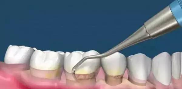 洗牙到底怎么洗好,洗牙洗的不干净