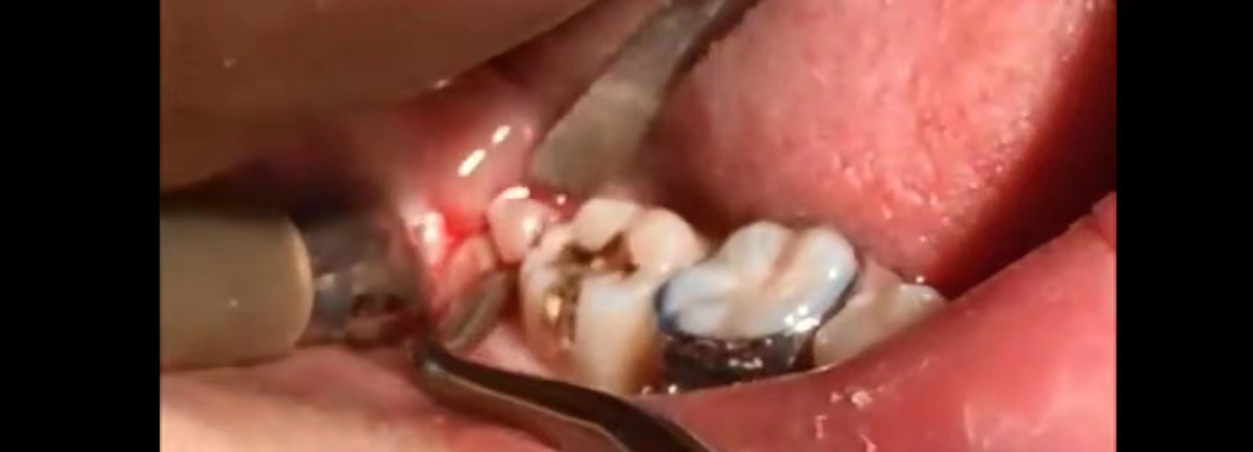 下颌阻生智齿拔除要流多少血,下颌低位水平阻生牙拔除图解