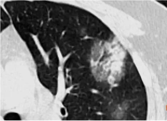 新型冠状病毒肺炎相关知识答疑,新型冠状病毒肺炎必须知道什么