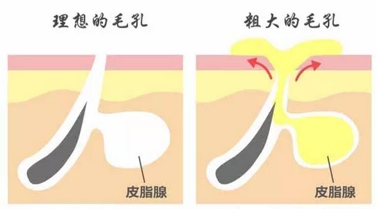 男士如何缩小脸部毛孔,脸部去黑头螨虫缩小毛孔