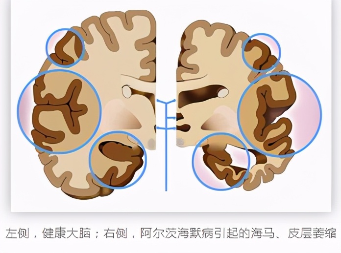 57岁查出脑萎缩正常吗,58岁查出脑萎缩还能活多久