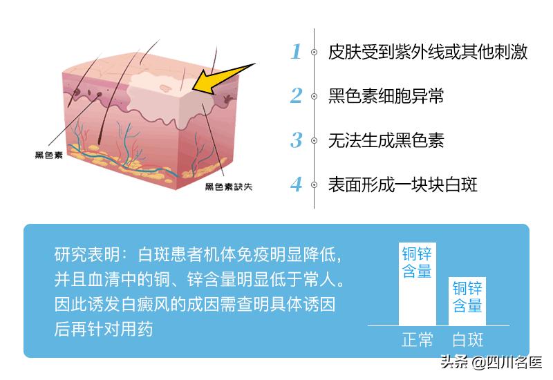 白癜风专家会诊,全国征集10名白癜风病友免费治疗