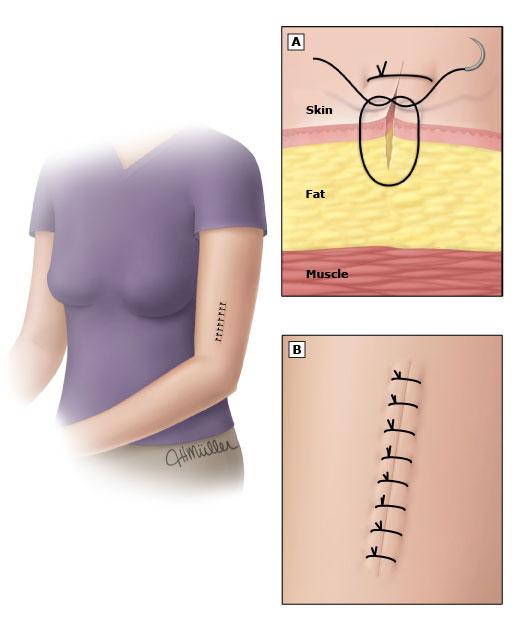 外伤缝合人工好还是订书机缝合好,骨科手术为什么用缝合钉