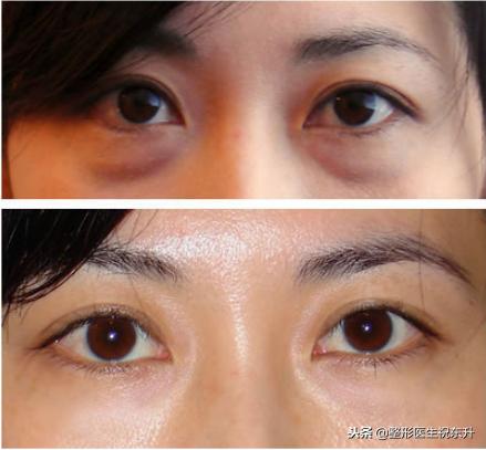 抽脂去眼袋和切口去眼袋效果对比,抽脂去眼袋后悔了