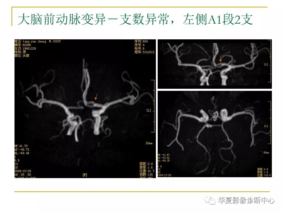 中国人脑立体定向mri应用解剖图谱,脑mri示意图