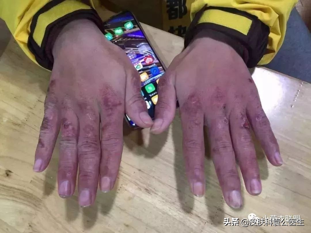 冻伤后痒痒是怎么回事,冻疮后期接触水干燥发痒怎么治