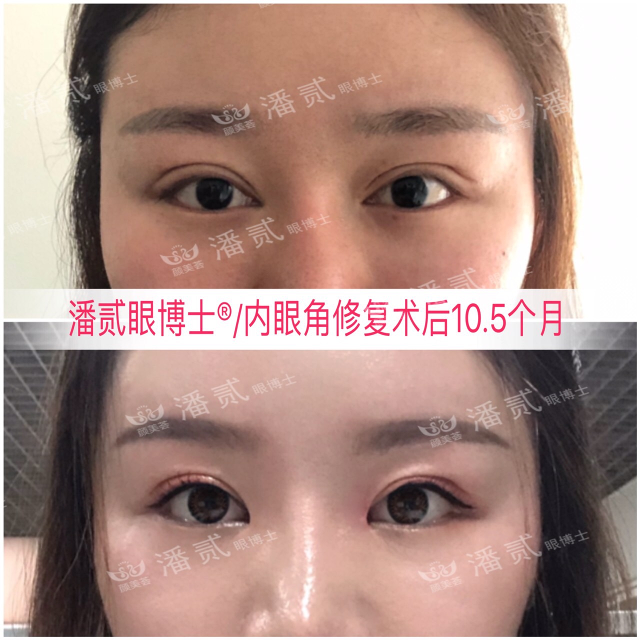 开内眼角会留疤的照片,开内眼角的疤痕变白色了怎么办