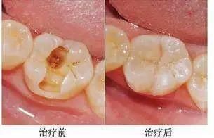 牙齿小洞不补下一句是什么,牙齿小洞不补大洞吃苦的意思