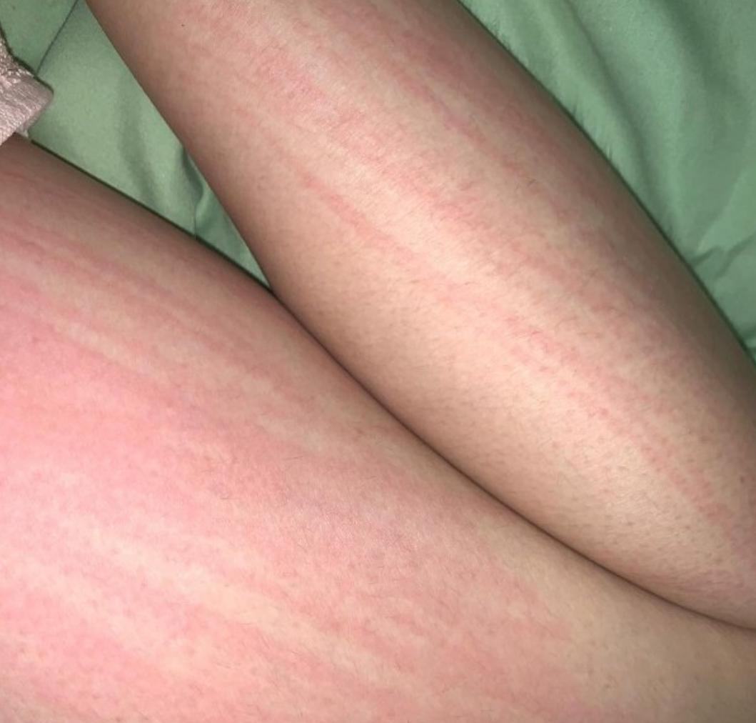 宅男女神邓月平戒口吃“草”曾荷尔蒙失调惹湿疹满身抓痕