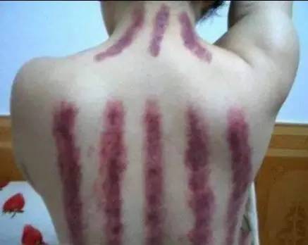 刮痧留下的印,刮痧后的痧怎么消得快