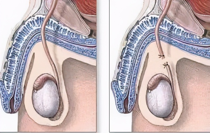 23岁男人可以结扎吗,23岁小伙结扎