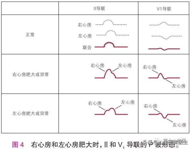 左右心室肥大发病原因,心脏肥大可以瘦回来吗
