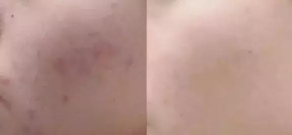 被青春痘困扰怎么办,被痘痘困扰的安慰