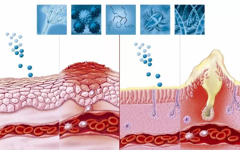 怎么区分激素脸和过敏脸,过敏脸与激素脸的区别
