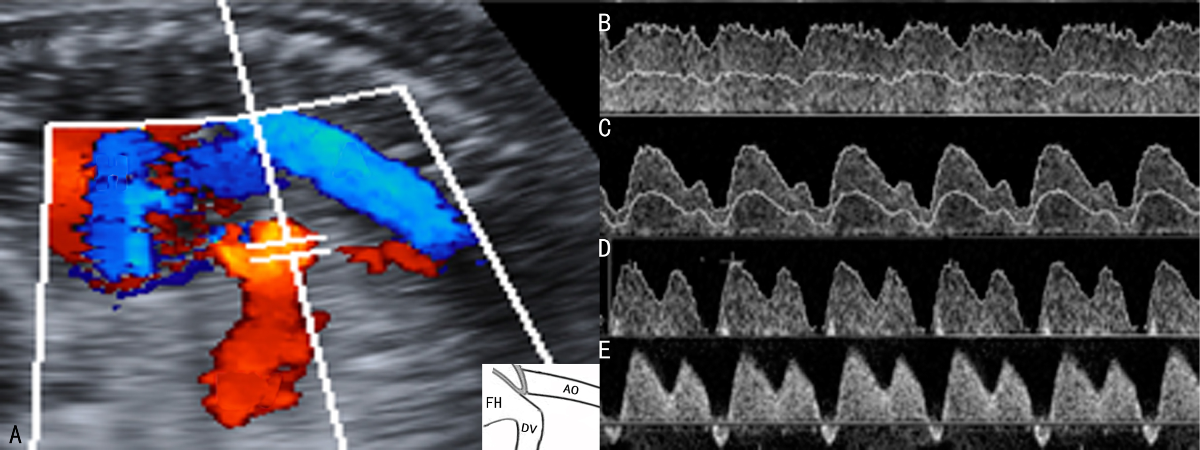 胎儿2级彩色多普勒超声图片,彩色多普勒胎儿超声诊断报告单