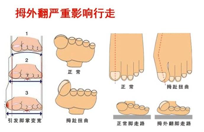 什么是大脚趾外翻,什么原因导致大脚趾外翻