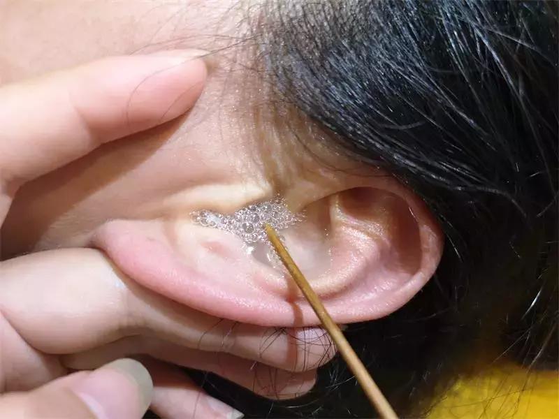 耳浴十分钟后需要清洗吗,耳浴消毒