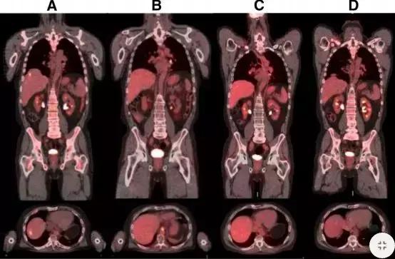 胃癌切除后基因检测与靶向治疗,基因测序治疗胃癌