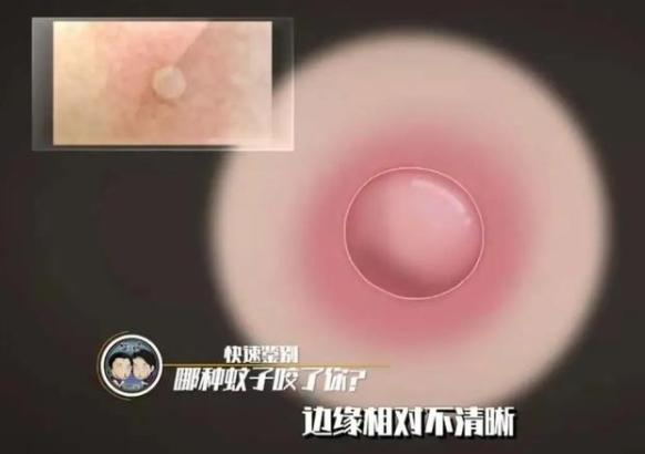 三种常见蚊子咬的包如何快速止痒消除,三种被叮的包要分清楚