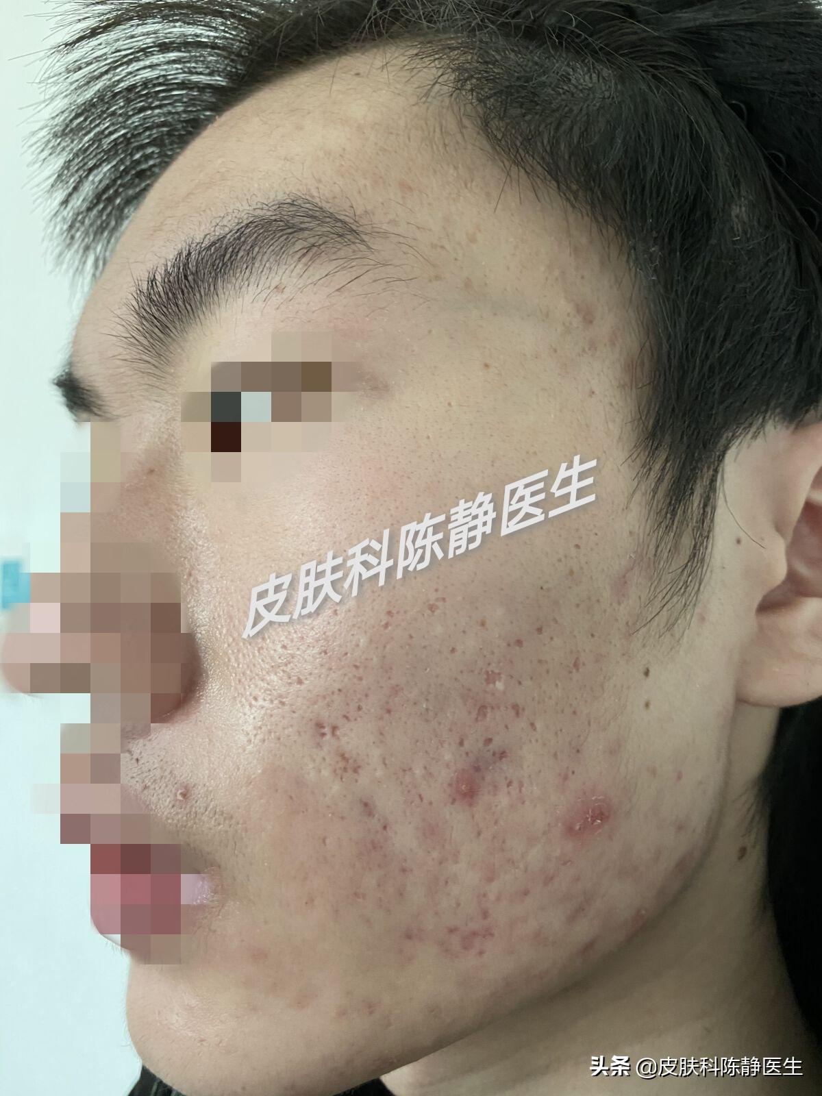 皮肤科刷酸要多长时间,医院皮肤科刷酸一次多少钱