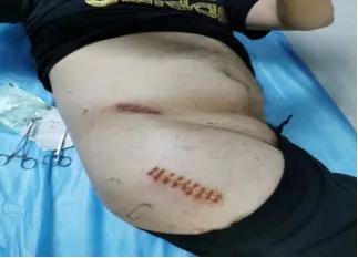 股骨头机器人手术微创,骨科机器人股骨颈手术