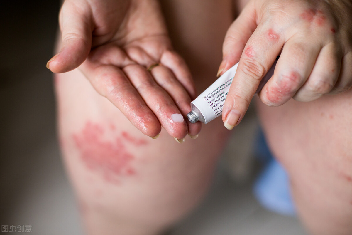 得了湿疹如何止痒,得了皮炎湿疹衣服如何杀菌处理