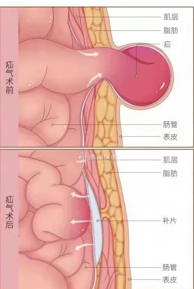 婴儿疝气开刀手术,疝气开刀要多少钱