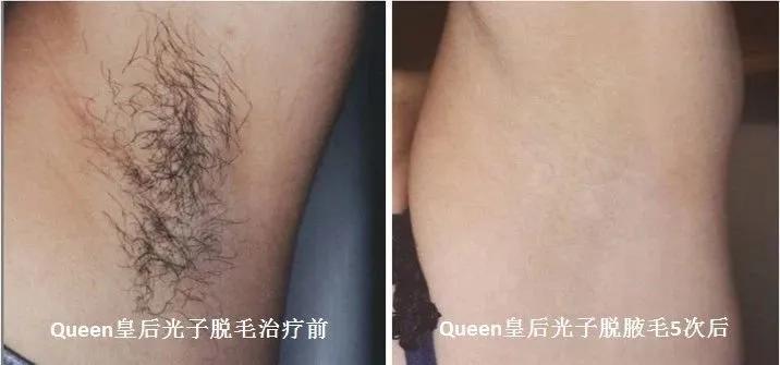 护肤光子嫩肤,光子嫩肤和脱毛操作