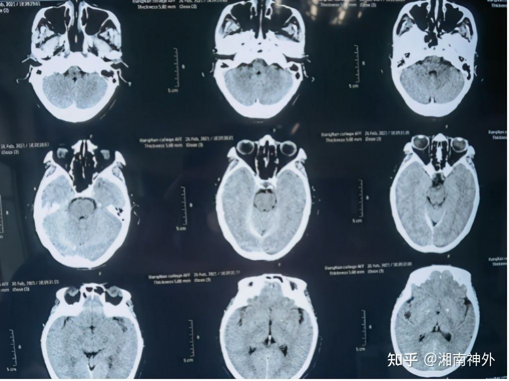 脑动脉瘤的定时炸弹,颅内定时炸弹