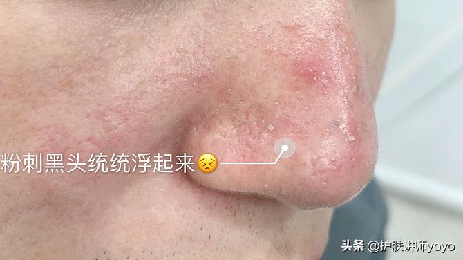 去黑头护肤正确过程,挤黑头之后怎么护肤