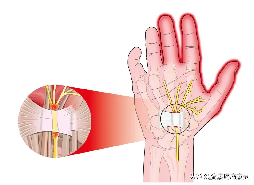 正中神经损伤治疗方法,正中神经损伤康复训练