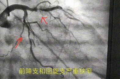 嗓子冒烟咳嗽很长时间也不好,嗓子冒烟儿