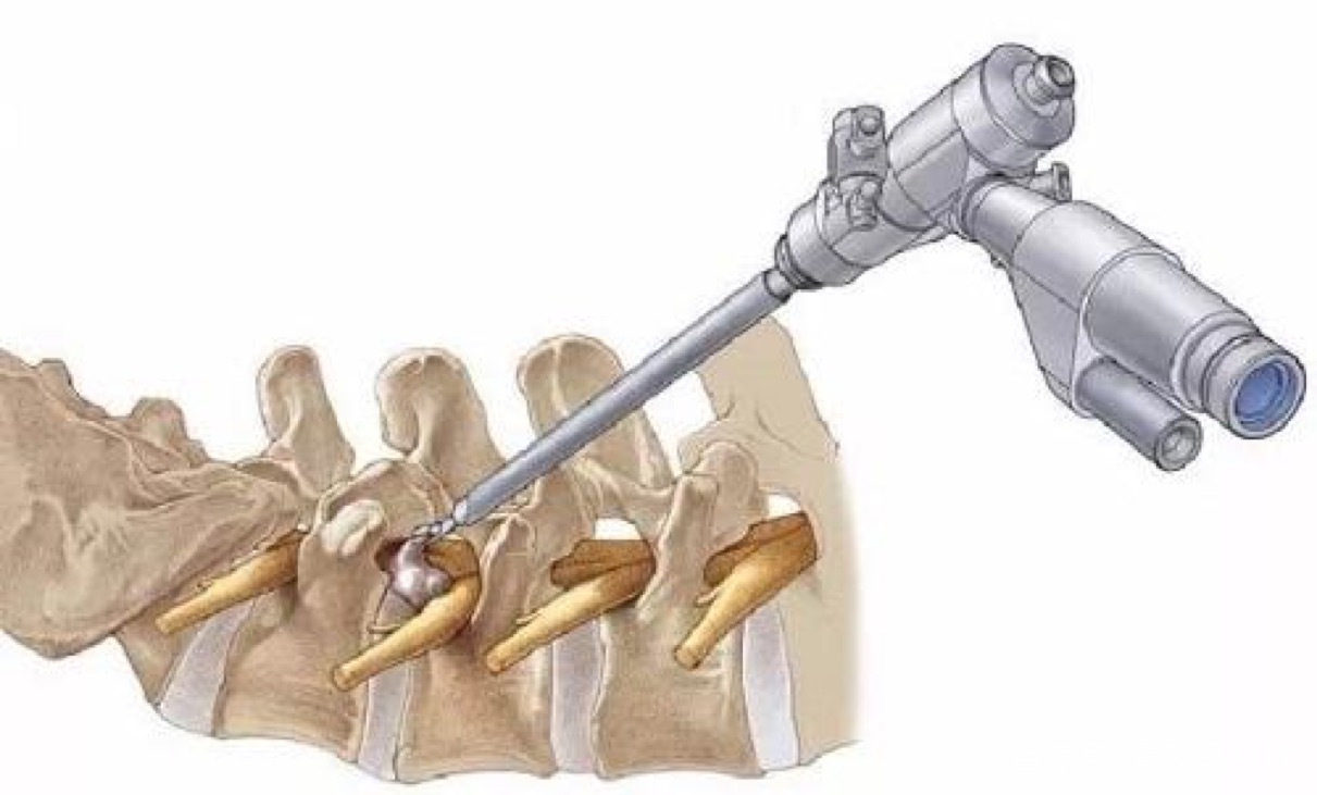腰椎开放手术好还是微创手术好,腰椎间盘突出微创手术是几级手术