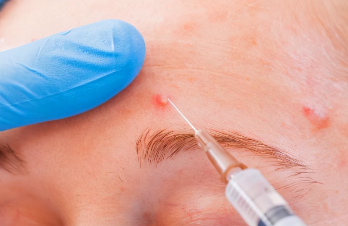 痘痘反反复复出现？预防复发，只要做好这4点