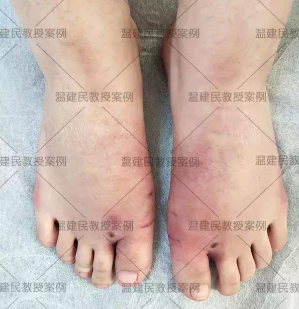 大脚骨怎么做手术好得快,什么样的大脚骨需要手术